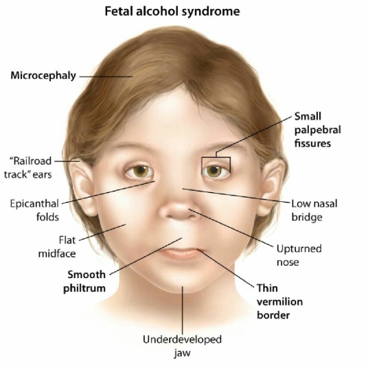 Fetal Alcohol Syndrome: Symptoms, Causes, Diagnosis, Treatment and More.
