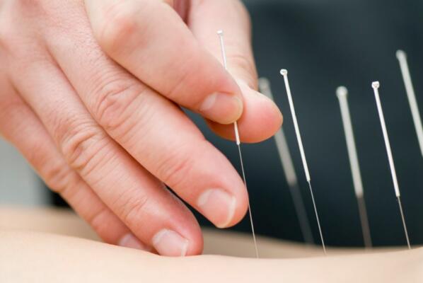 accupuncture