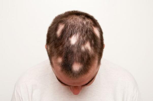 Hair loss : Symptoms, Causes, Diagnosis, Treatment and More