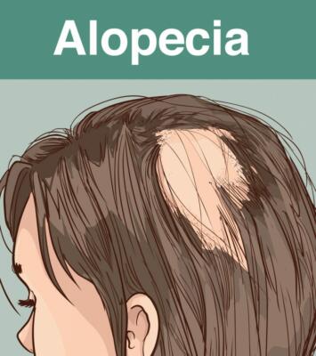 Allopecia