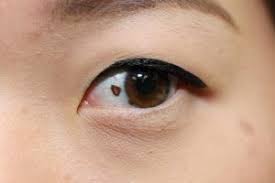 melanoma in eyes