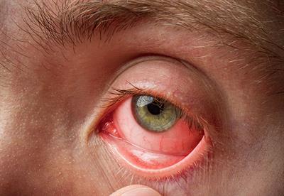 conjuctivitis