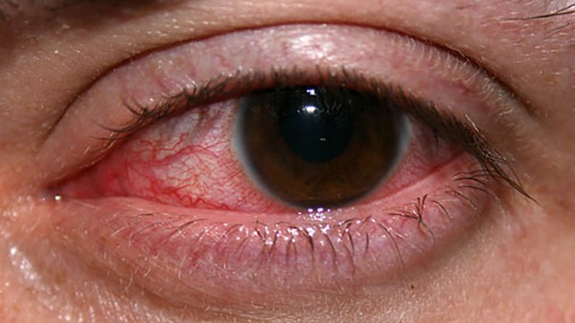 Infections Of The Eye Causes Symptoms Treatment And More Daily