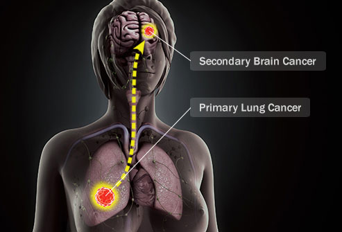 types of cancer