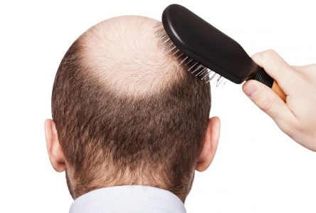 Hair Loss Reason? What type of vitamin deficiency causes hair loss?
