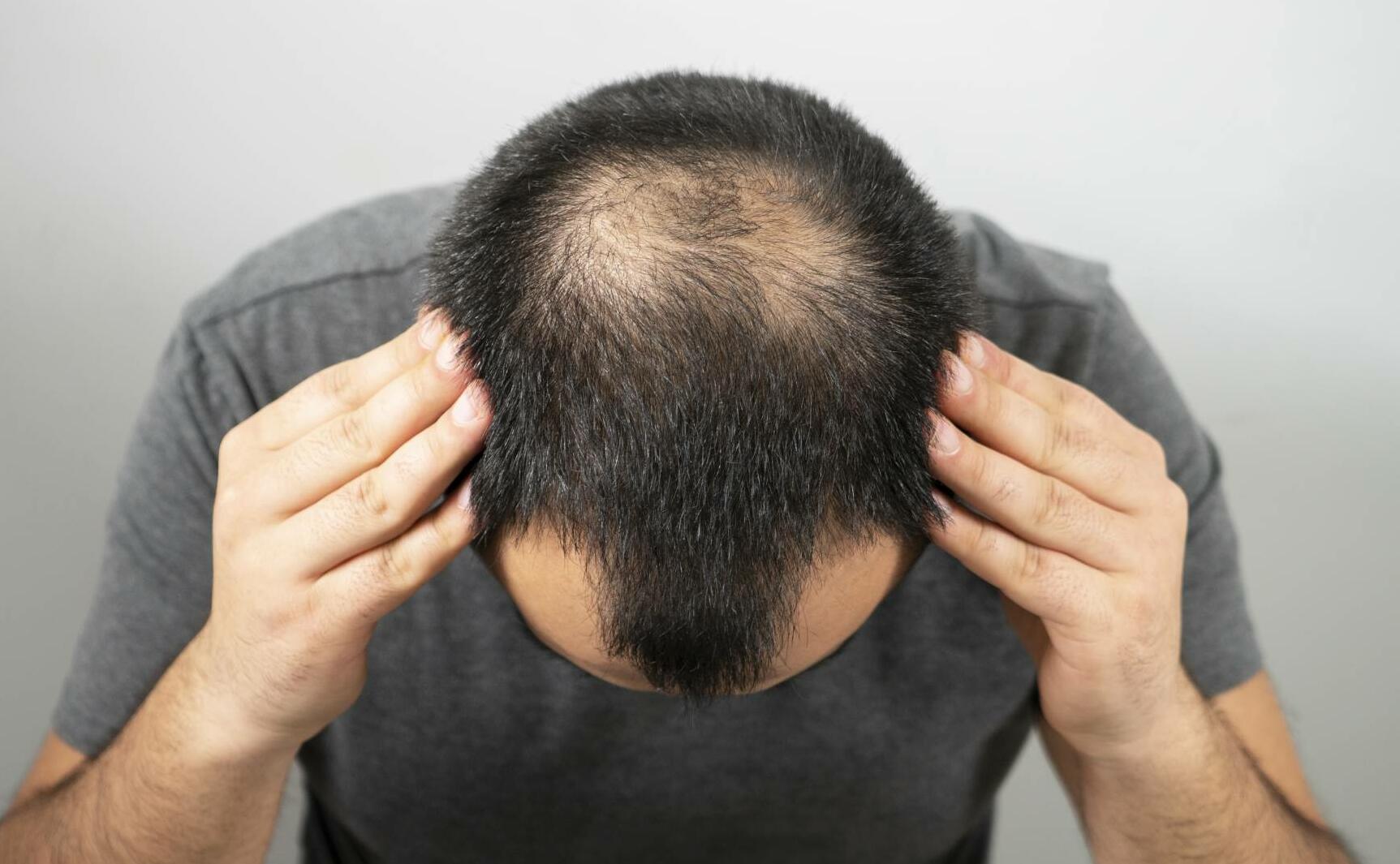 Buy Hair Loss Treatment Online Daily Chemist