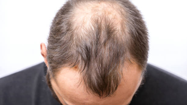 10 things you should know about hair thinning in men